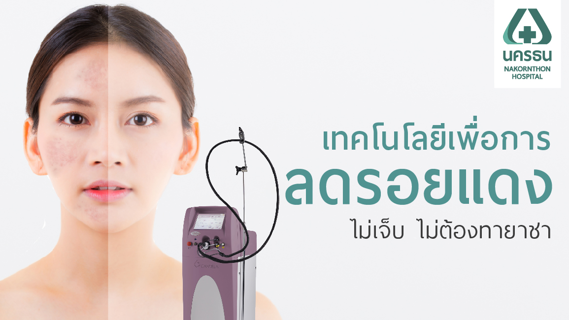 Vbeam เพื่อผิวเนียนใส ไร้รอยสิว